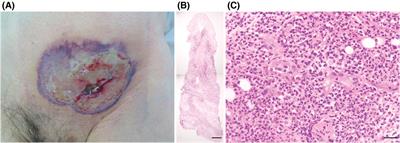 Postoperative pyoderma gangrenosum in a patient undergoing long-term nivolumab therapy